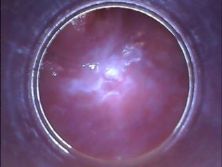 RAW endoscopic video-8